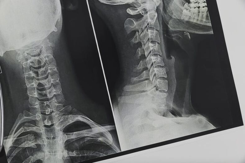 osteochondrosis سے متاثرہ گریوا ریڑھ کی ہڈی کا ایکس رے