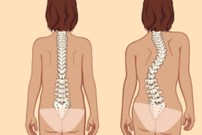 thoracic osteochondrosis کے ساتھ کھڑا کرنسی اور scoliosis