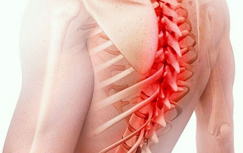 چھاتی کی ریڑھ کی ہڈی کی osteochondrosis
