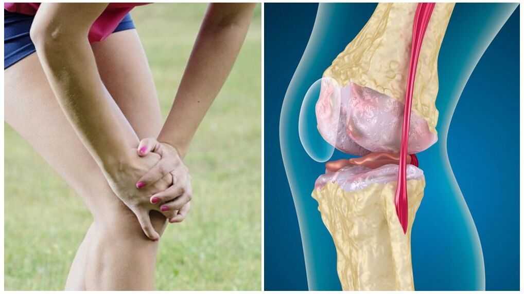 arthrosis کی علامات
