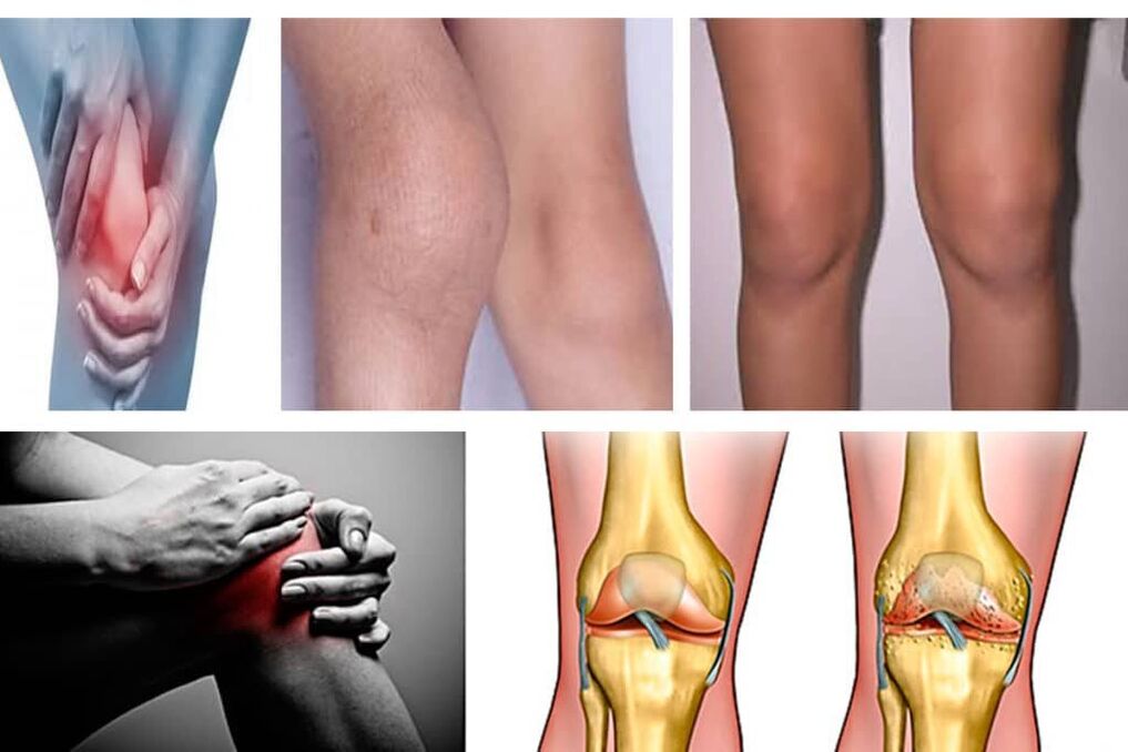 arthrosis یہ کیا ہے